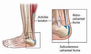 Achillespeesklachten - Achillodynie - Ontsteking of irritatie van de achillespees of de slijmbeurs